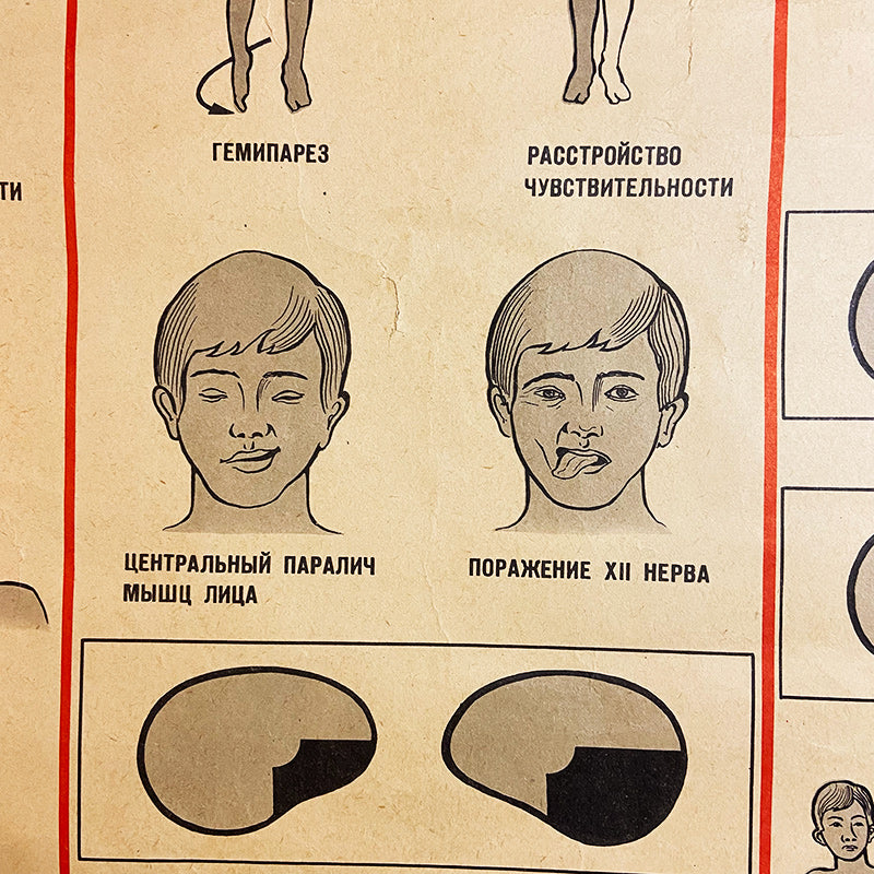 Brain blood supply disorders, Medical poster, Ukrainian SSR, 1981