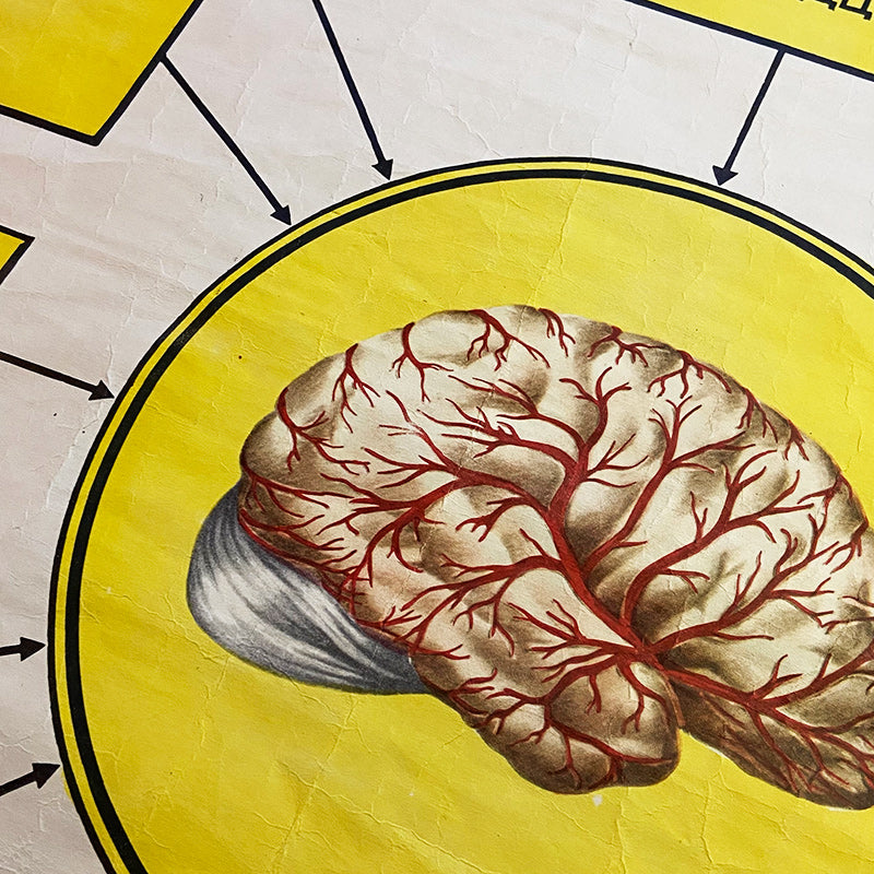 Etiology of cerebrovascular accidents, Medical poster, Ukrainian SSR, 1984